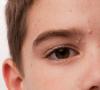 Forma de acné pustular papilar: causas y tratamiento