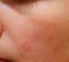 Tworzenie się alergicznych plam na ciele, ich odmianach i przyczynach